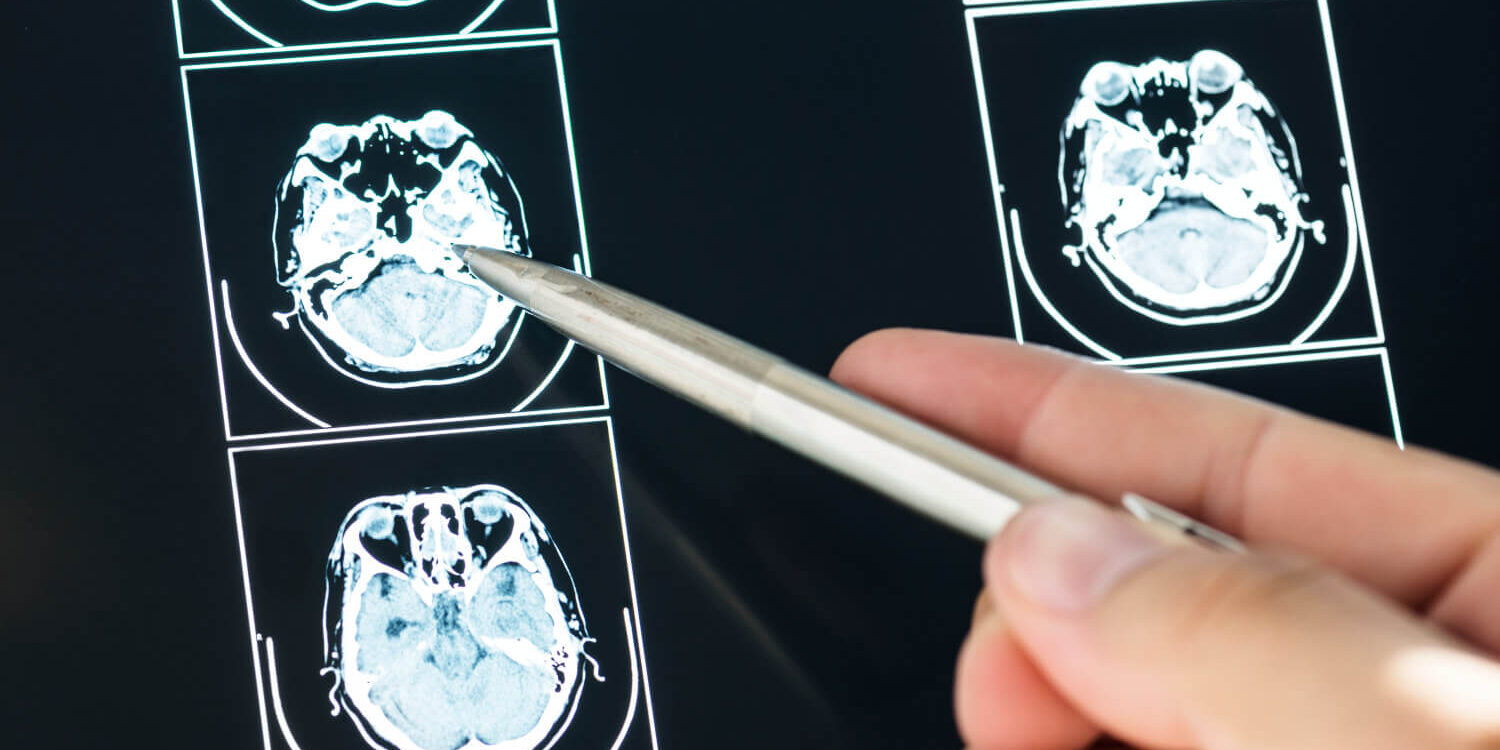 Muerte súbita por epilepsia