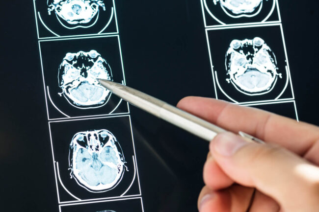 Muerte súbita por epilepsia Muerte súbita por epilepsia